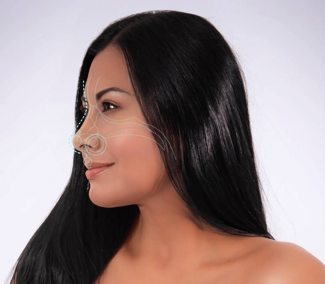 Rostro de perfil con guías de marcación, referencia de rinoplastia estructural